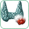 tiroidectomia subtotale